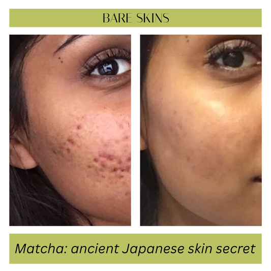 Acne Control Matcha Mask